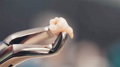 Extracción de dientes retenidos