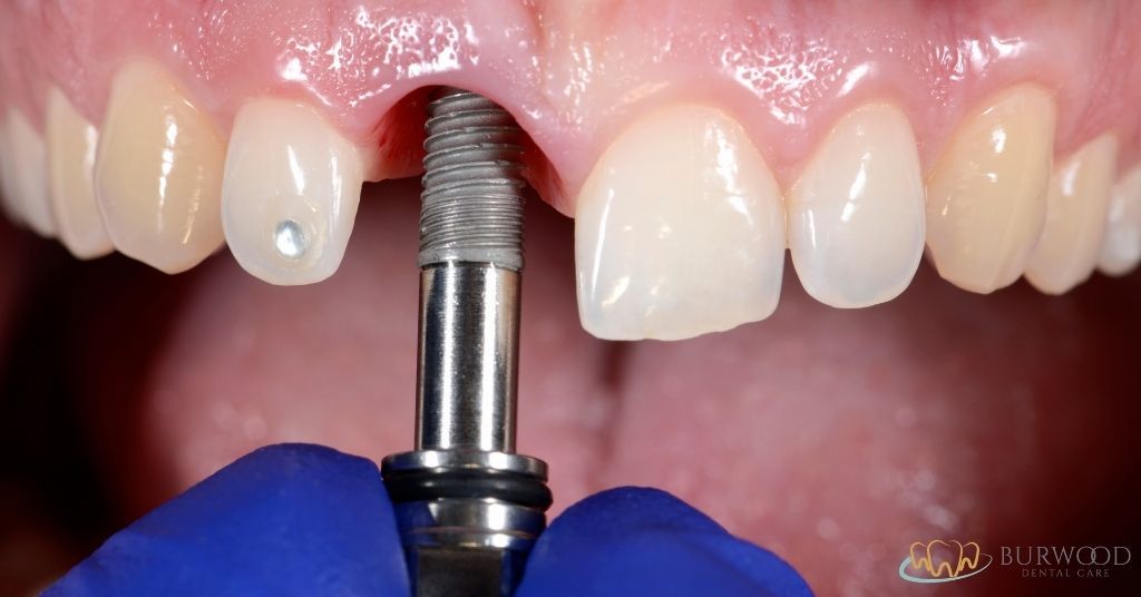 Implantes Dentales