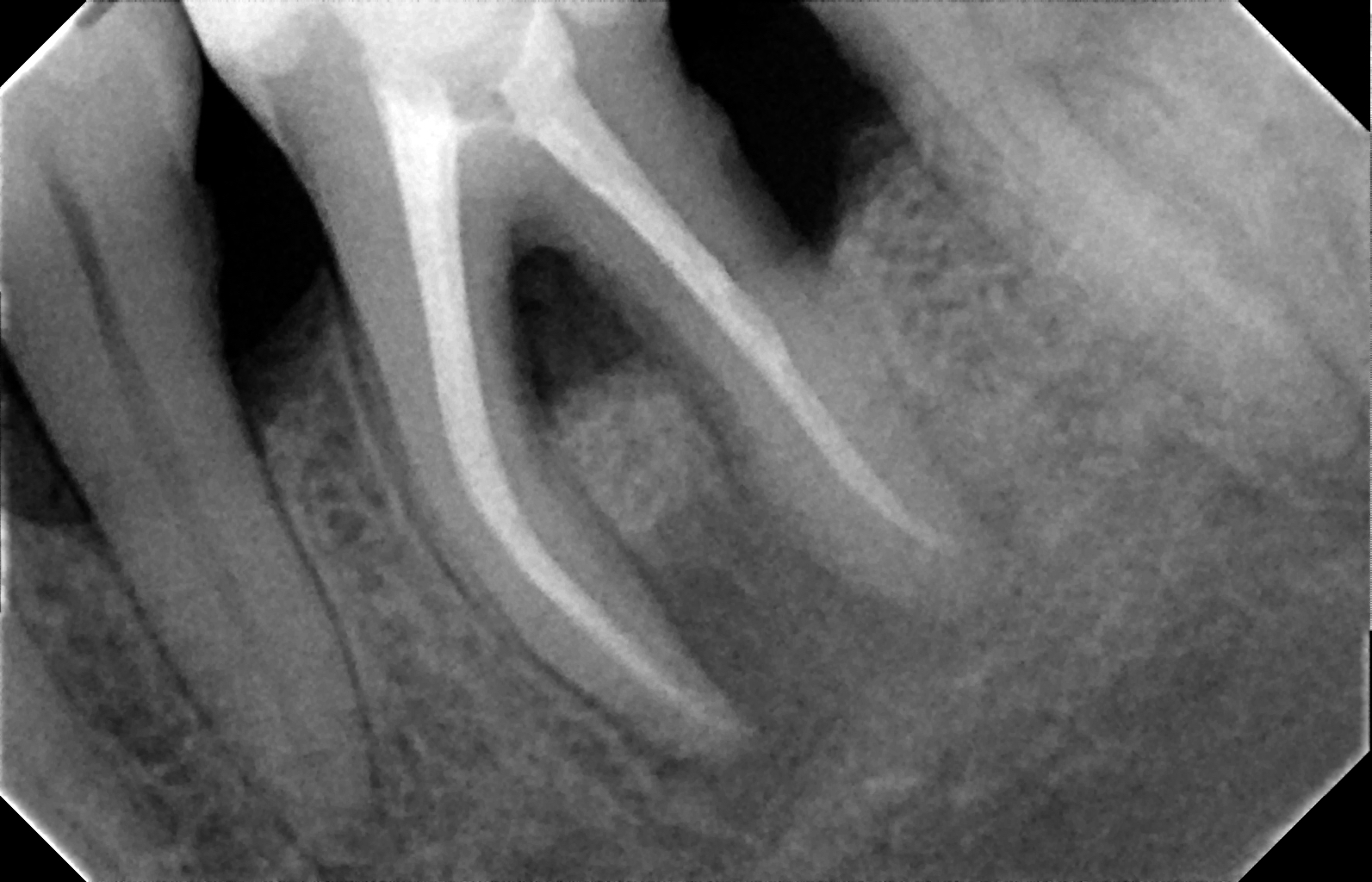 Tra tamiento de conducto