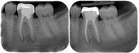 Retratamiento de conducto