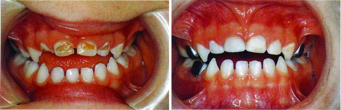 Restauraciones dentales en dientes temporarios