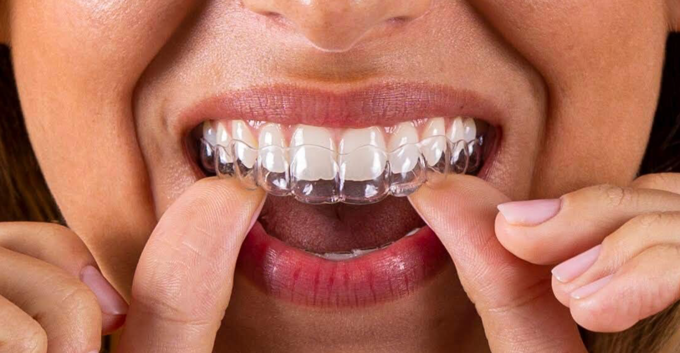 Alineadores Dental Soho