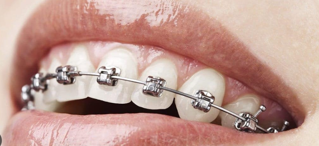 Brackets autoligables