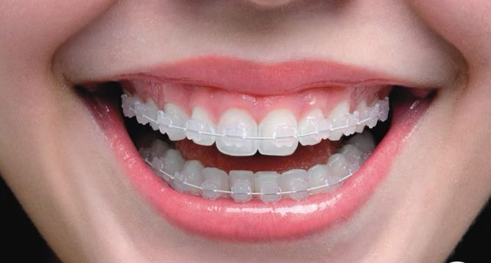 Brackets de porcelana