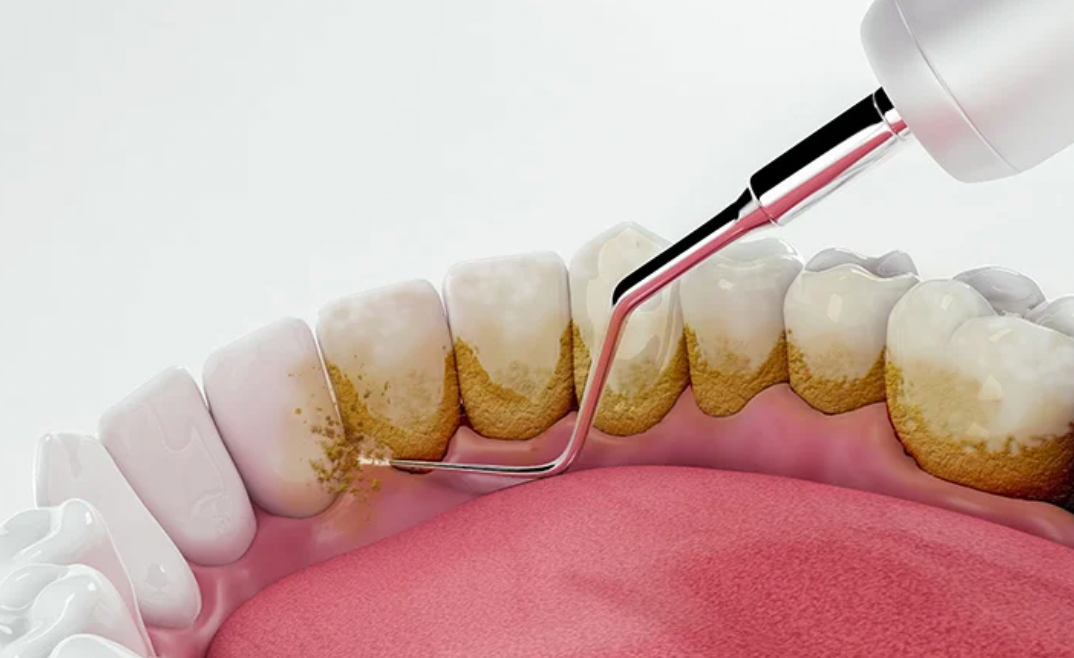 Limpieza Periodontal